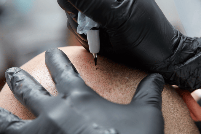 .Edge Scalp Ink SMP scalp micropigmentation in Bethesda, Maryland
