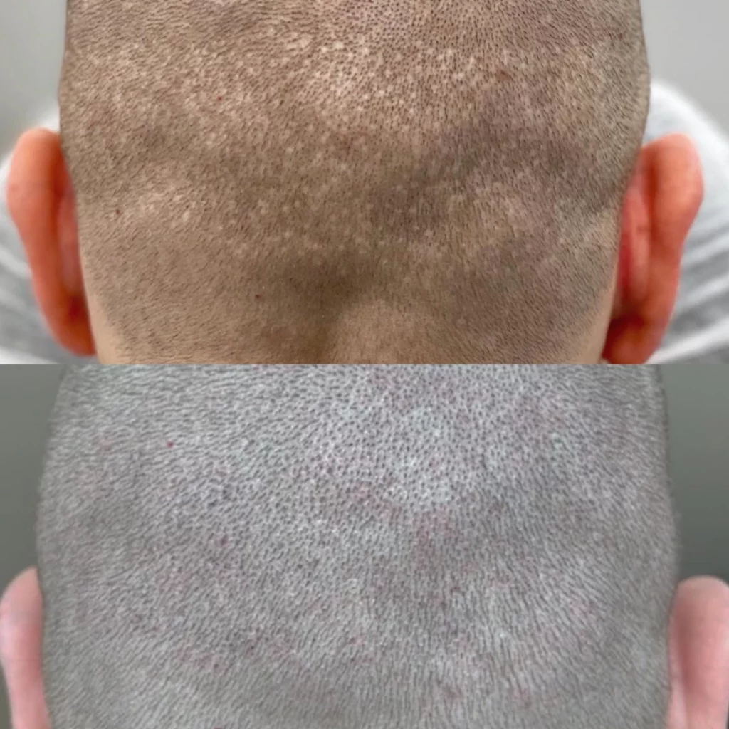 before and after scar camouflage scalp micropigmentation treatment