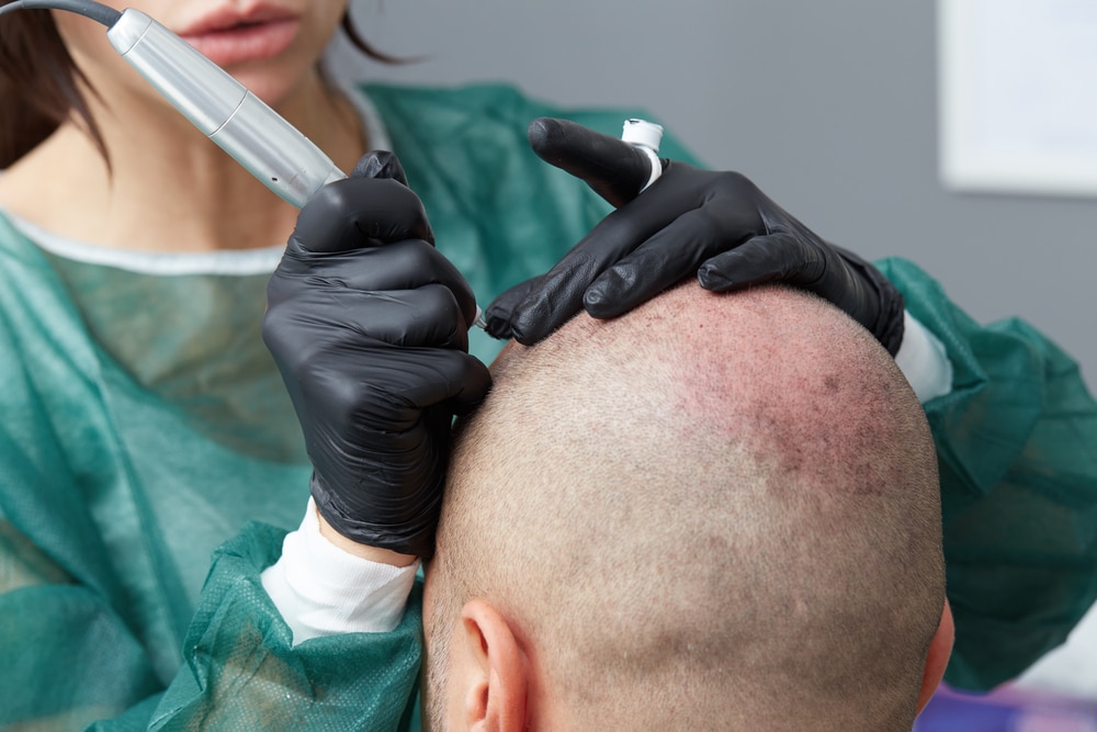 Covering Scars with Scalp Micropigmentation