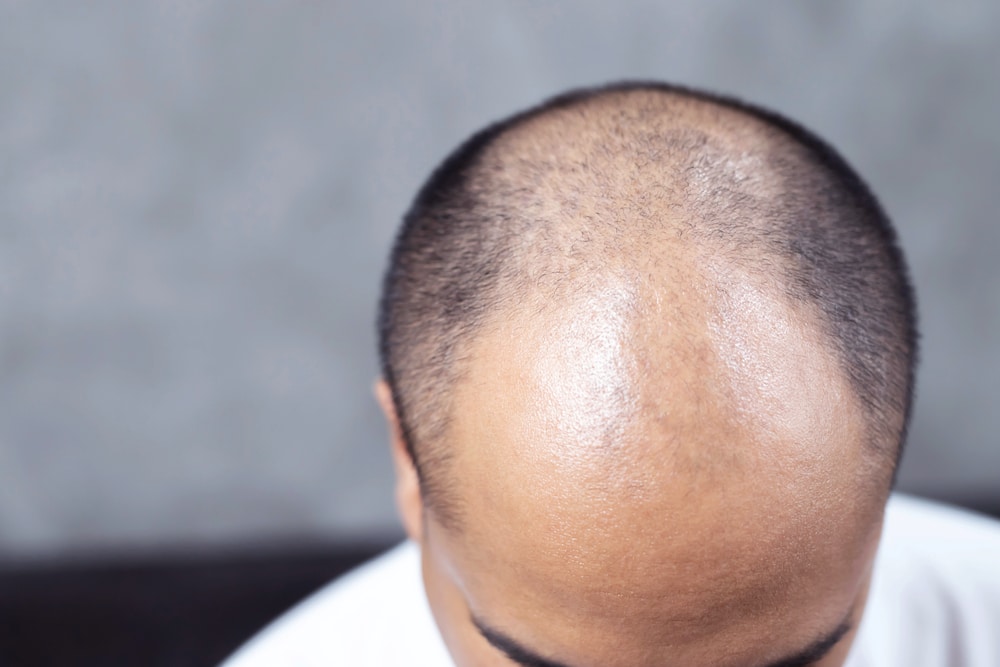 Where to Go for the Best Scalp Micropigmentation in the DMV
