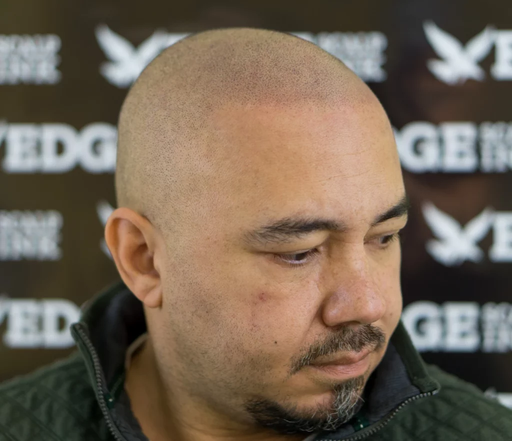 The Truth About Light and Dark Scalp Micropigmentation