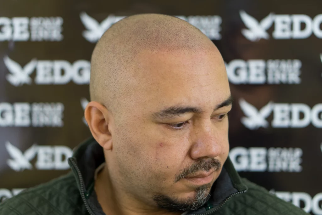 Hispanic Latino man before and after scalp micropigmentation treatment at Edge Scalp Ink in Silver Spring, Maryland