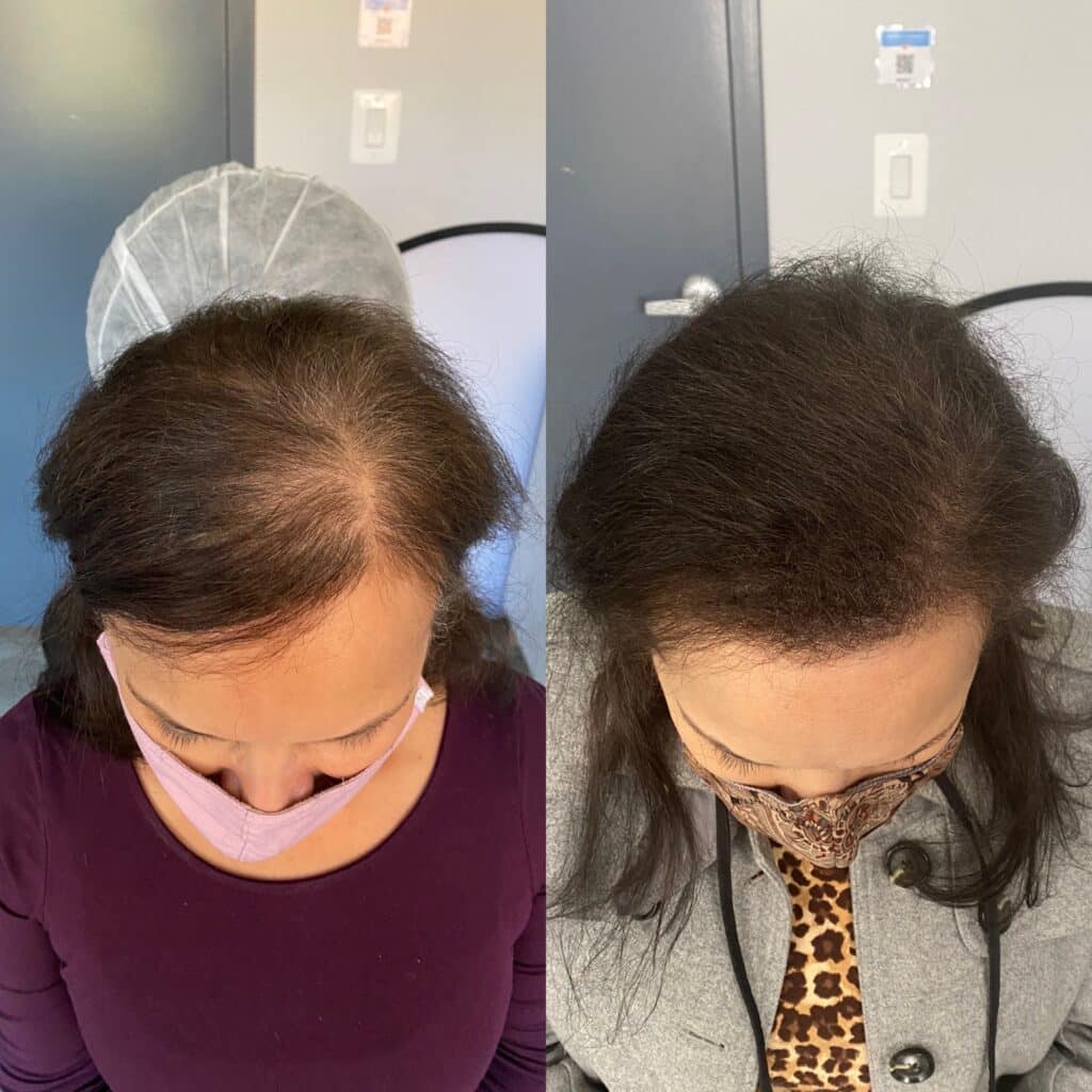 Helmet Head - Botched Scalp Micropigmentation