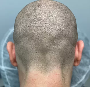 SMP for Scar Camouflage