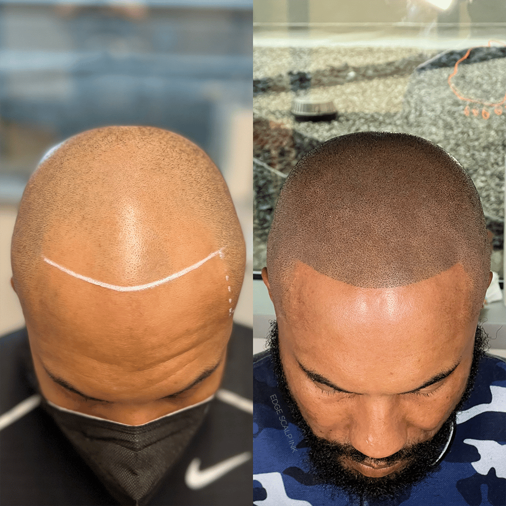 Helmet Head - Botched Scalp Micropigmentation