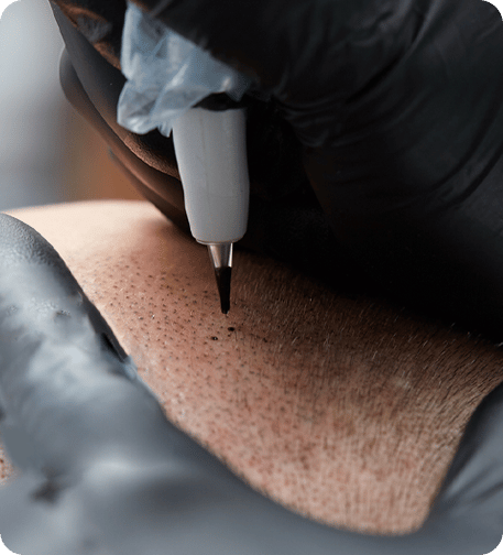 treatment close up scalp micropigmentation