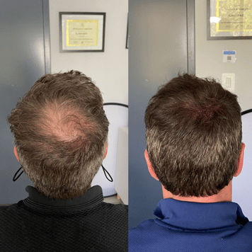 Edge Scalp Ink scalp micropigmentation SMP Maryland DMV Washington DC Virginia