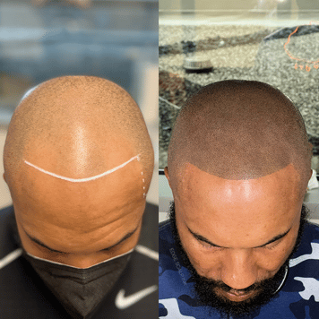 Edge Scalp Ink scalp micropigmentation SMP Maryland DMV Washington DC Virginia