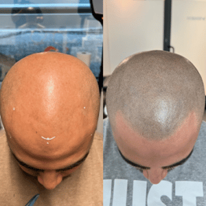 Edge Scalp Ink scalp micropigmentation SMP Maryland DMV Washington DC Virginia