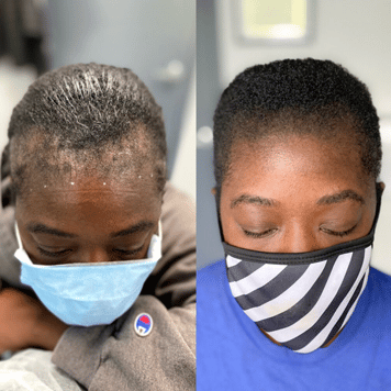 Edge Scalp Ink scalp micropigmentation SMP Maryland DMV Washington DC Virginia