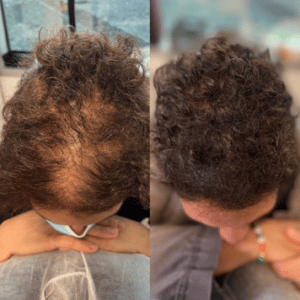 Edge Scalp Ink scalp micropigmentation SMP Maryland DMV Washington DC Virginia