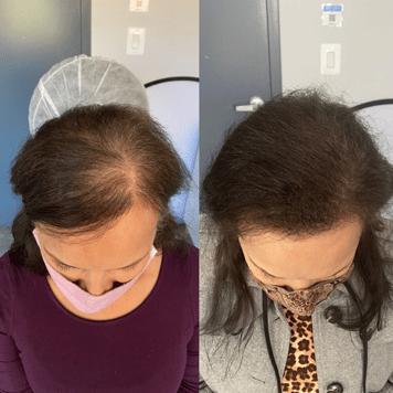 Edge Scalp Ink scalp micropigmentation SMP Maryland DMV Washington DC Virginia