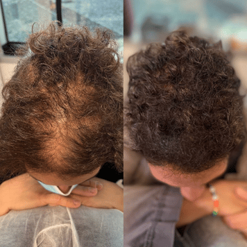 Edge Scalp Ink scalp micropigmentation SMP Maryland DMV Washington DC Virginia