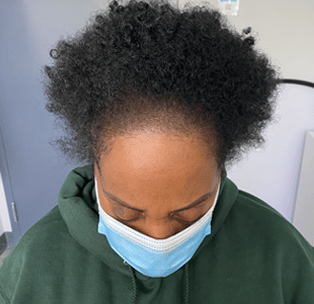 Women's Edges | Baby hairs | scalp micropigmentation | SMP | traction alopecia