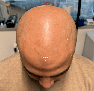 Scalp Micropigmentation before treatment SMP
