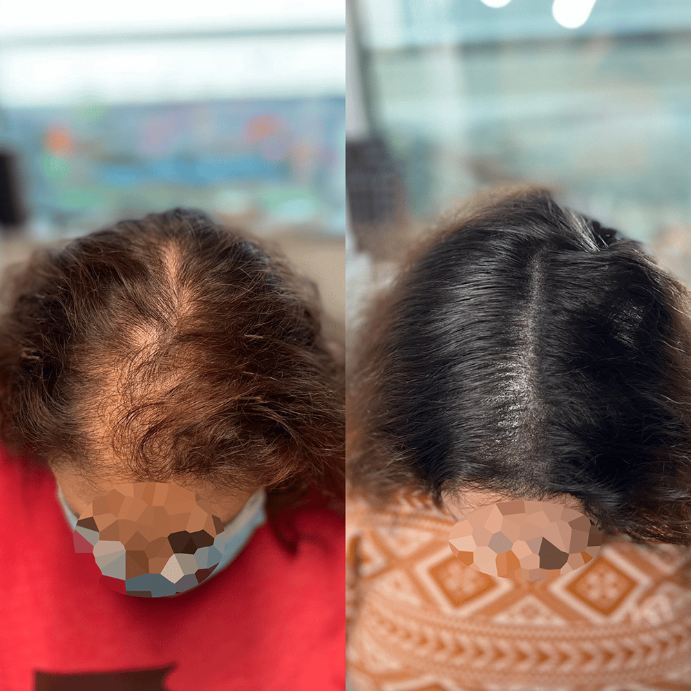Hair tattoo\ scalp micropigmentation for women's alopecia