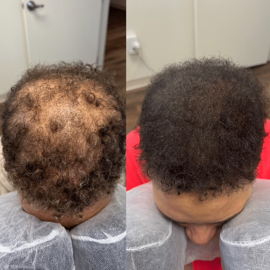 Curly hair African American woman with alopecia areata. Before and after photo.