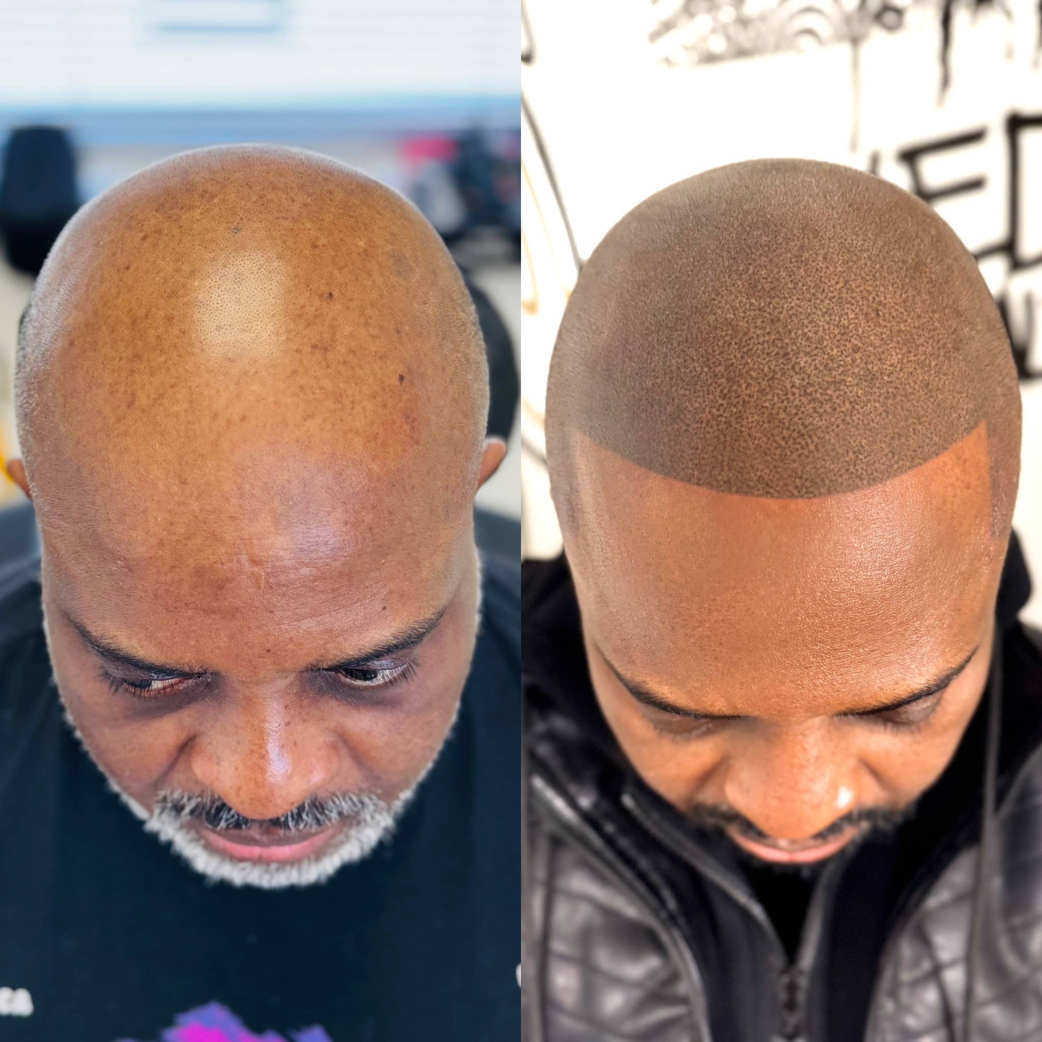 African American male client's photo of before and after scalp micropigmentation treatment with Edge Scalp Ink.