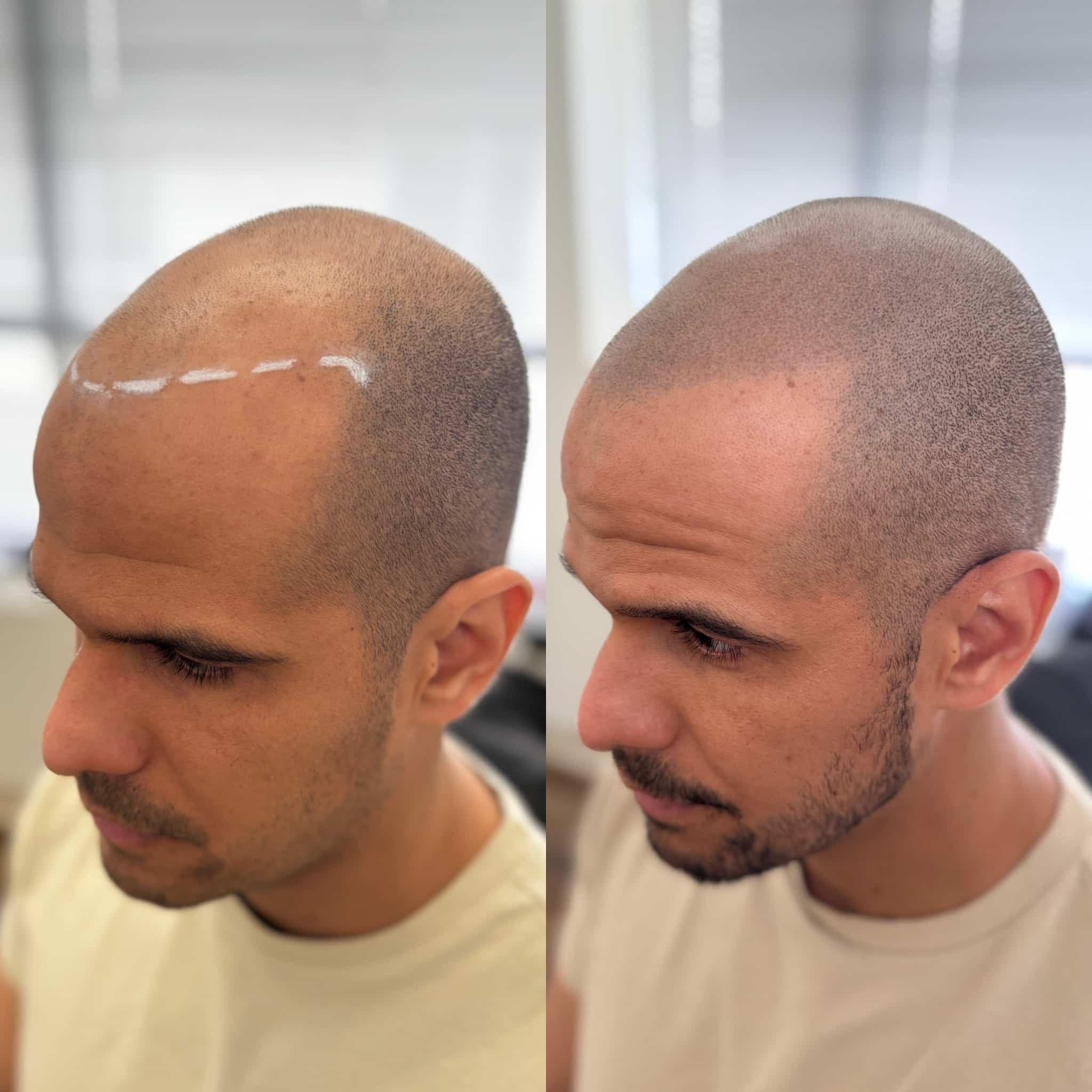 Before and After phot of men's scalp micropigmentation for density